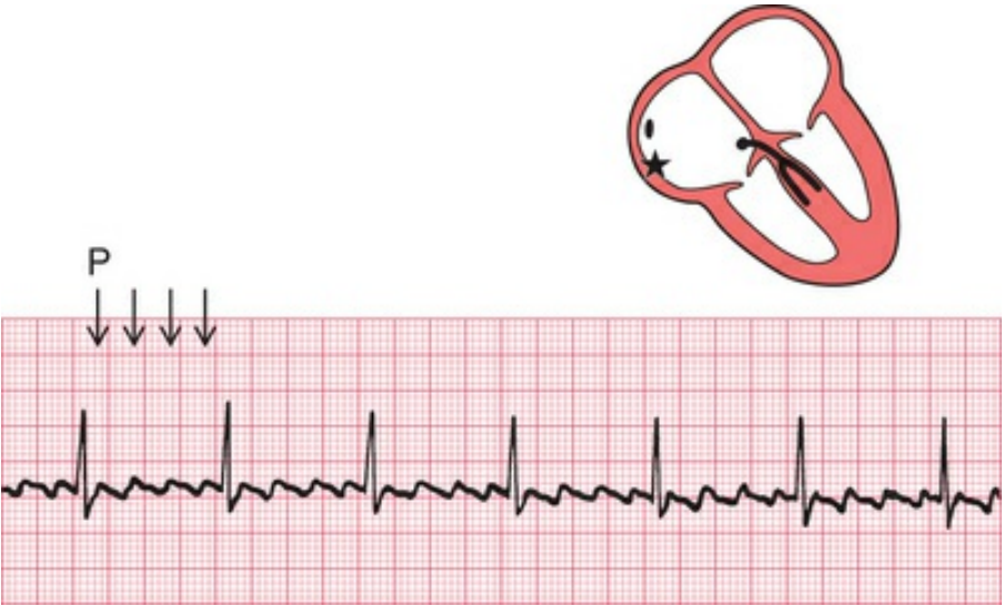atrial flutter
