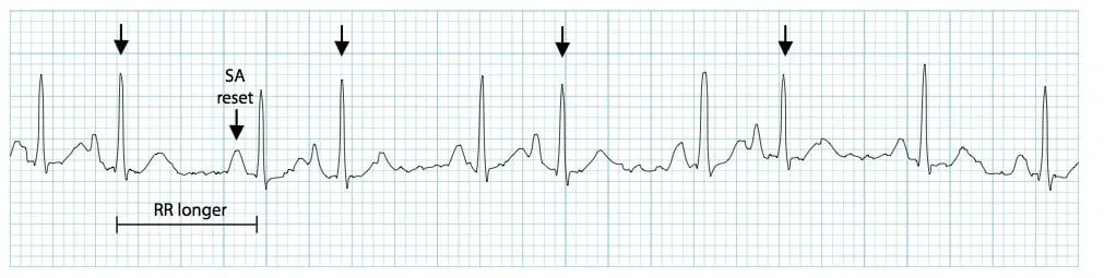 Premature Atrial Complex PAC
