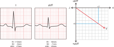 tentukan defleksi qrs
