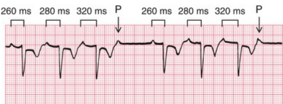 Cara Baca EKG