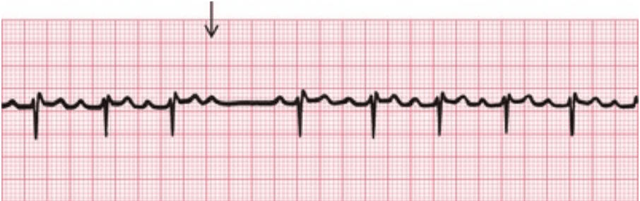 AV Blok derajat II mobitz 2