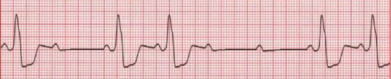 Cara Baca EKG