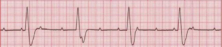 Cara Baca EKG